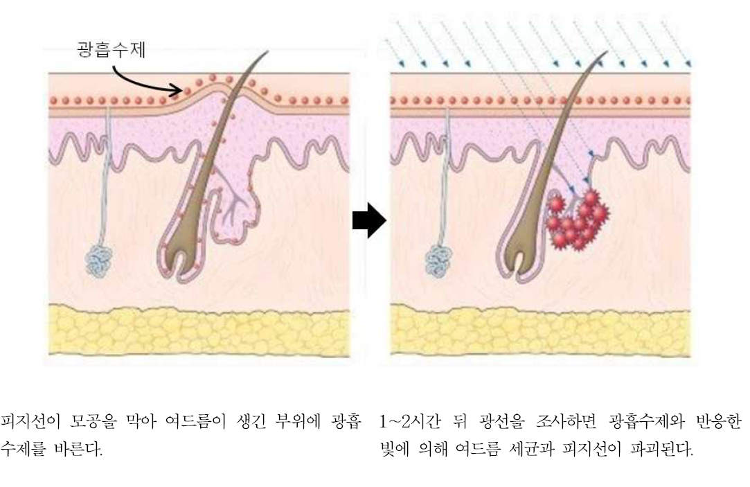 광역동 치료의 과정