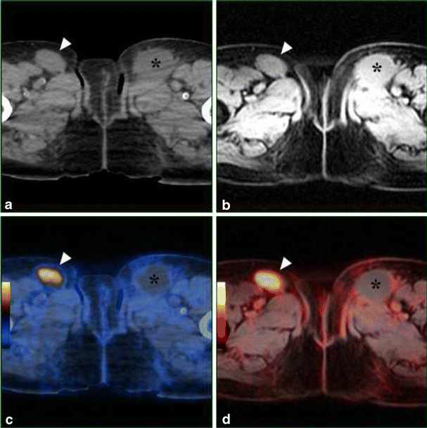 (a) low-dose CT (b)MRI (c) PET-CT (d) PET-MRI 악성 흑색종의 확산 전이를 촬영한 사진