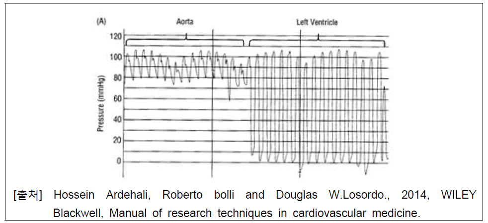 카테터의 좌심실 삽입전후 압력파형 변화