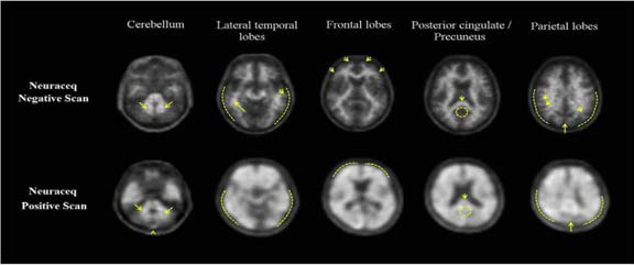 플로르베타벤(18F) PET 음성스캔(위)과 양성스캔(아래) 예시