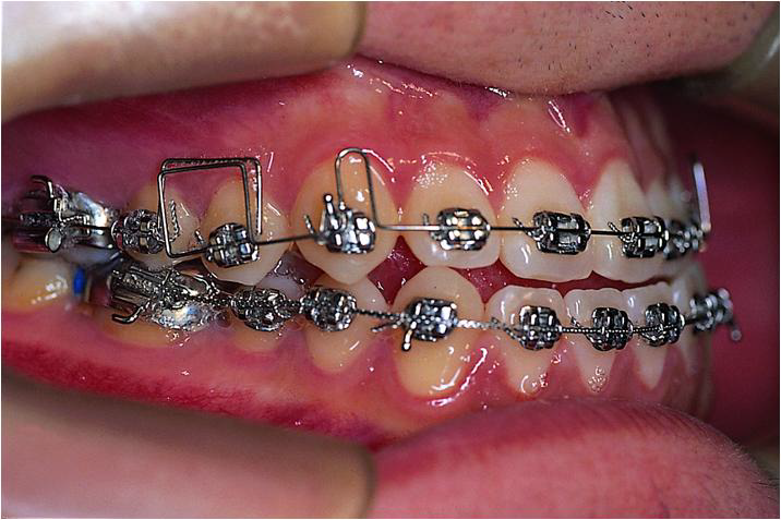 The photograph of metal bracket in mouth.