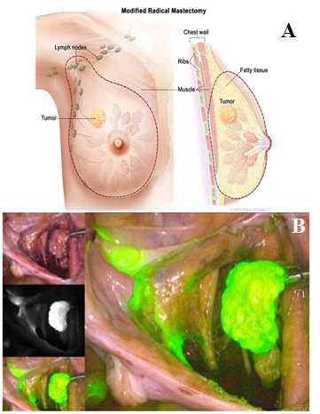 ICG를 이용한 유방암의 종양 표식.