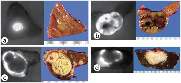 간 절단면의 NIR 형광 영상 패턴(왼쪽)과 육안적 소견에 의한 간암의 절단면(오른쪽)을 나타내고 있다