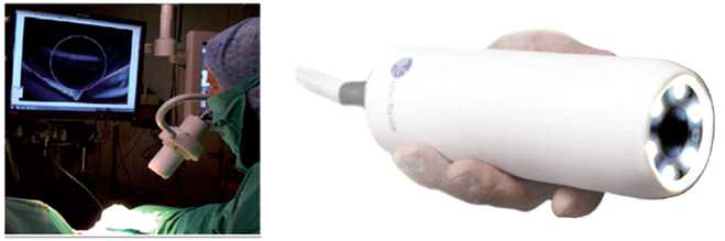 The FluobeamTM device provides a real-time quantitative image of fluoresce in the operating environment