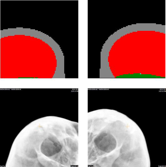 X-ray images obtained from PCXMC and Exactrac system for tumor located right part of the brain