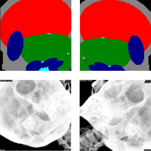 X-ray images obtained from PCXMC and Exactrac system for tumor located lower part of the brain