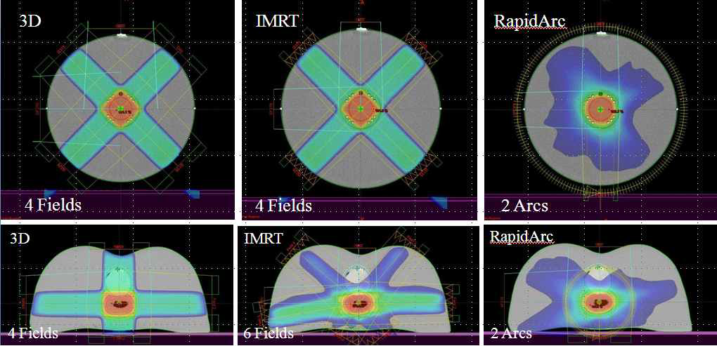 위의 상단 3개 그림은 좌측부터 원통형 PMMA 팬텀에 대한 3D CRT, IMRT, Rapidarc 치료계획의 선량 분포를 보여주며 하단의 3개 그림은 좌측부터 실리콘 팬텀에 대한 3D CRT, IMRT, Rapidarc 치료계획의 선량 분포를 보여준다.