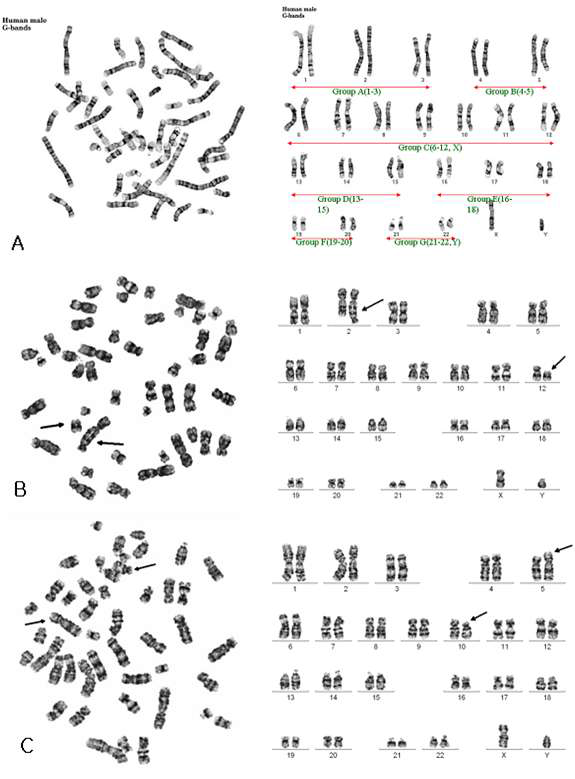 G- banding을 통한 염색체 이상 분석.