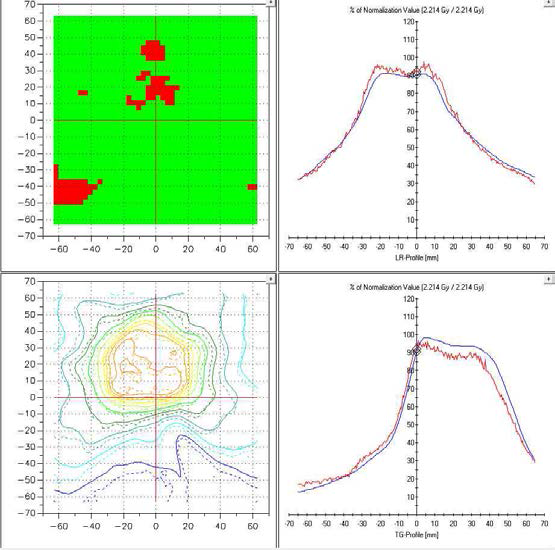 전립선암환자의 방사선치료 계획( LF plan) 을 필름을 이용하여 검증한 결과. Gamma - index 3%- 3 mm로 분석한 결과 91.99%의 일치함을 나타내었다.