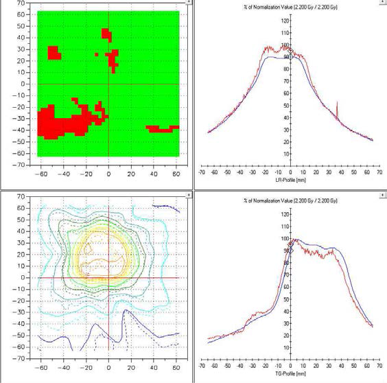 전립선암환자의 방사선치료계획( RF plan) 을 필름을 이용하여 검증한 결과. Gamma - index 3%- 3 mm로 분석한 결과 87.06%의 일치함을 나타내었다.