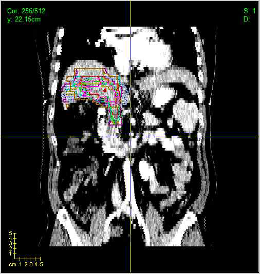 Window level 중 liver mode