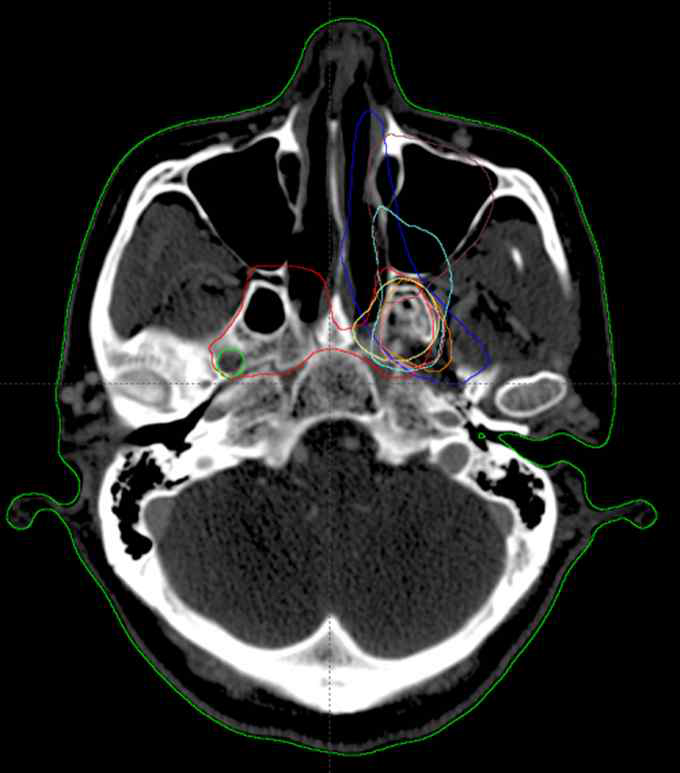 재발 된 두경부 암 환자군에 대한 대표 CT 영상의 표적용 인체 윤곽선