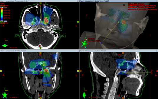 두경부 암 재발률의 공간적 분포도 구현 ( red= high cancer recurrence rate, blue= low cancer recurrence rate)