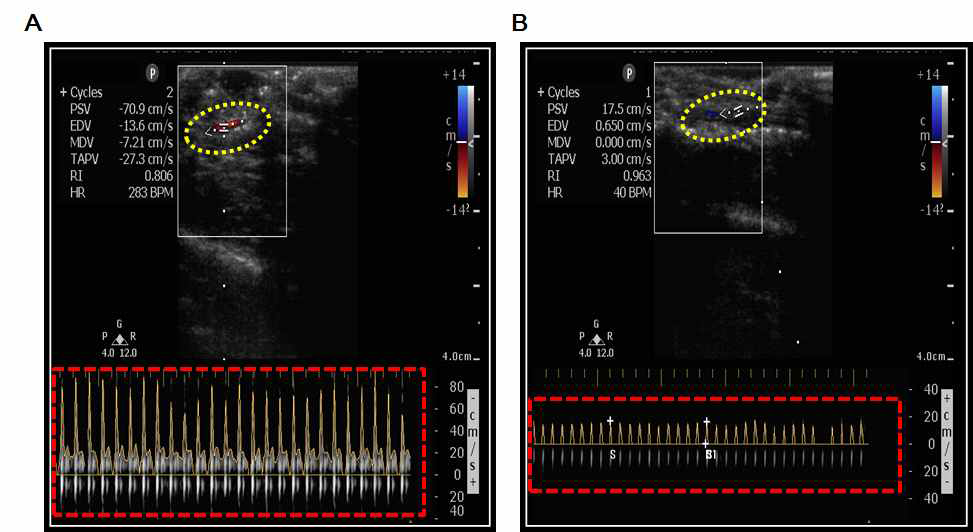 Monitoring of carotid artery blood flow in topical FeCl3-induced carotid artery injury rat model. A 3×5 mm strip of filter paper saturated with or without 10% FeCl3 was applied to surface of surgically exposed left carotid artery as described in“ Materials and Methods.”After 20 days, carotid artery blood flow was measured using doppler flow probe (7.2 MHz). A: Normal (non-treated group). B: Control (topical FeCl3-treated group).