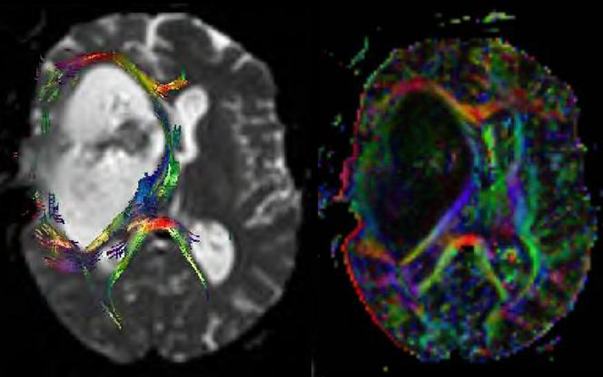 Diffusion tensor imaging을 활용한 종양볼륨분석