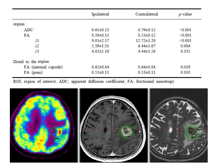 영상융합최적화를 이용한 T1 weighted image와 PET영상의 temporal tumor 최적화