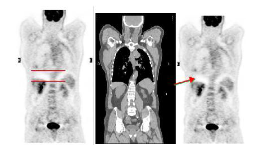 CT attenuation에서는 Frequency 50% 이상에서 호흡에 의한 attenuation correction artifact.