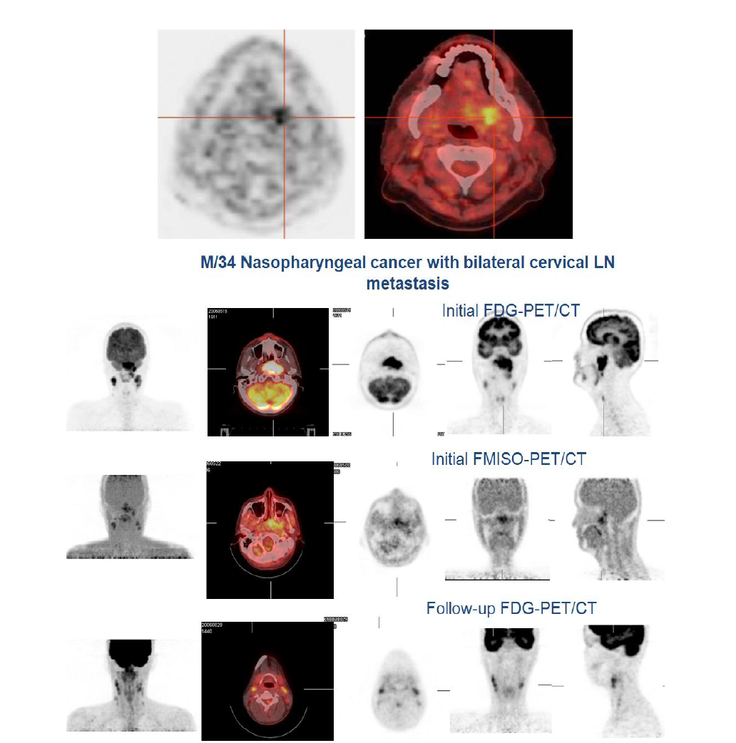 Nasopharyngeal cancer PET.