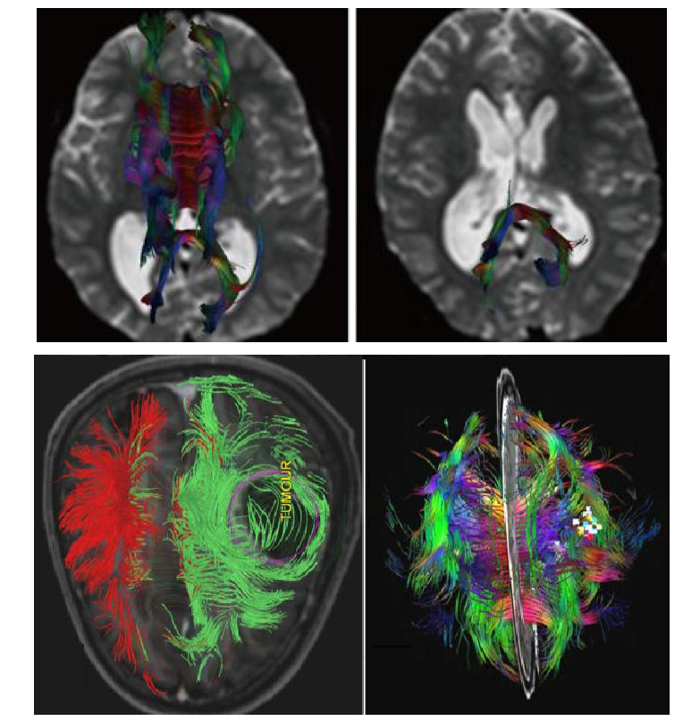 Diffusion tensor tractography 를 시행하여 종양조직의 tumor volume최 적화를 수행하기위한 WM fiber의 tractography분석.