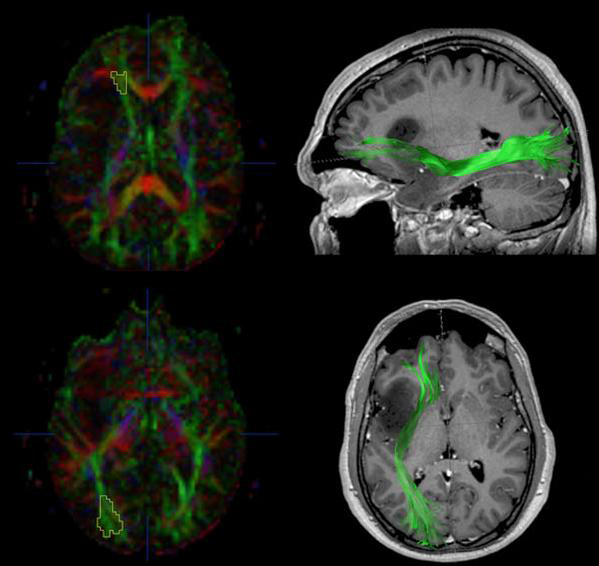 뇌종양은 뇌종양에 인접한 뇌 백질 섬유로의 위치와 방향이 변형되는데 확산 텐서 영상과 diffusion trctography 로 뇌 백질을 분석하여 MRI와 영상융합하여 임 상활용함.