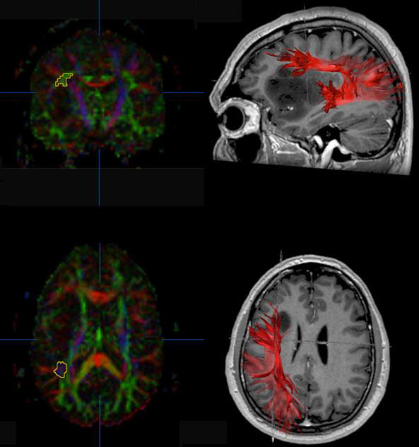 뇌 백질 tractography 로 종양에 의한 백질 섬유의 침습을 평가하고자 하였 고 대부분의 보고는 뇌 백질 섬유로가 종양에 의해서 끊기거나 편위(deviation)되고 있음