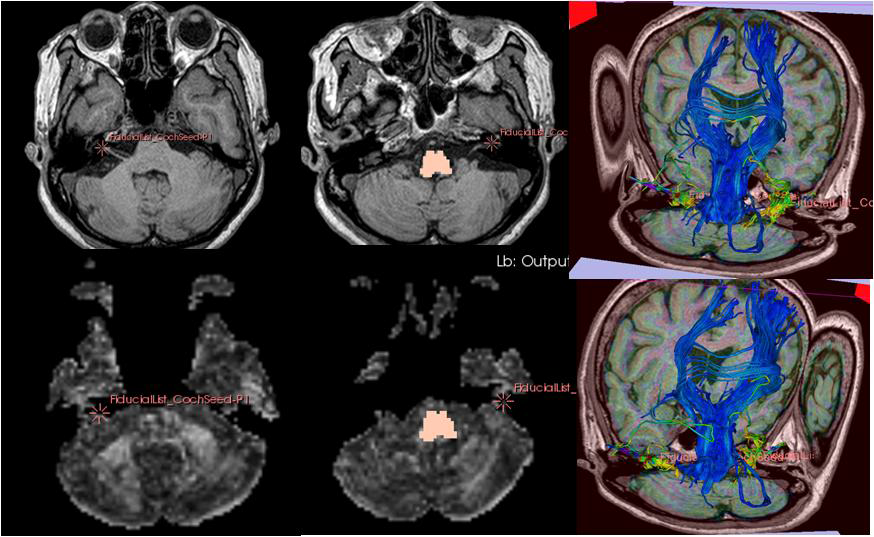 확산영상을 확산텐서영상과 normalized mutual information으로 영상융합하 여 MRI based 영상분할하여 종양볼륨분할하면 영상융합과 분할을 최적화 (아)Tractography 는 fiber tract의 stream line으로 fiber tract 이 종양조직을 만나 면 fiber tract의 stream line의 방향이 바뀌면서 Tumor volume optimize 효과를 거 둘 수 있다.