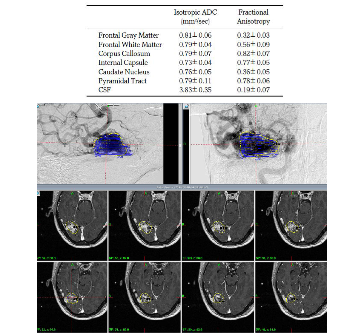 Arteriovenous malformation radiosurgery