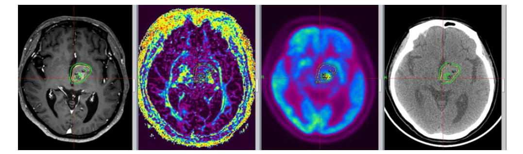 대사영상적용 방사선 수술 최적화 수행을 위한 normalized mutual information registration방법으로 융합한 MRI, Diffusion, PET, CT 확산강조영상이 제공하는 확산도는 세 방향의 다른 확산경사자계를 가한 뒤 얻은 정 보로 계산된 값으로써 실제로는 3차원적인 운동을 하는 스핀들의 성상을 나타내기에 는 불충분하다.