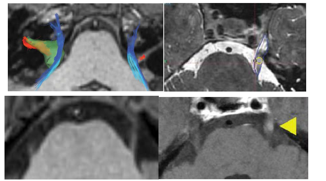 청신경초종과 삼차신경통의 방사선수술에서의 임상활용을 보면 삼차신경 (trigeminal nerve)는 tractography상에서 푸른색으로 안면신경(facial vestibular complex)는 붉은색 fiber track으로 구분하여 방사선 치료 및 방사선 수술을 위한 치 료계획을 결정할 때 뇌기능의 손상을 최소화 하는데 유용하게 활용됨.
