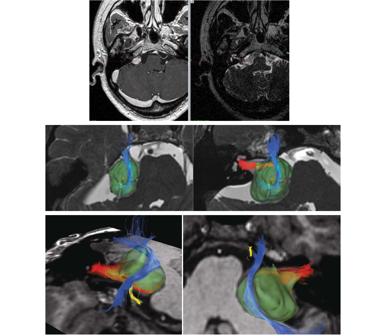 다중영상기반 생물학적 진단 기술을 활용한 청신경초종과 삼차신경통에서의 tractography 분석과 뇌정위적방사선수술 최적화기술을 방사선 수술에 적용하여 임상 활용한 것으로 다중영상 기반 생물학적 진단 기술은 종양최적화로 수술 부위를 최적화 하여 임상활용에 유용하게 활용.