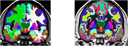 Brain segmentation