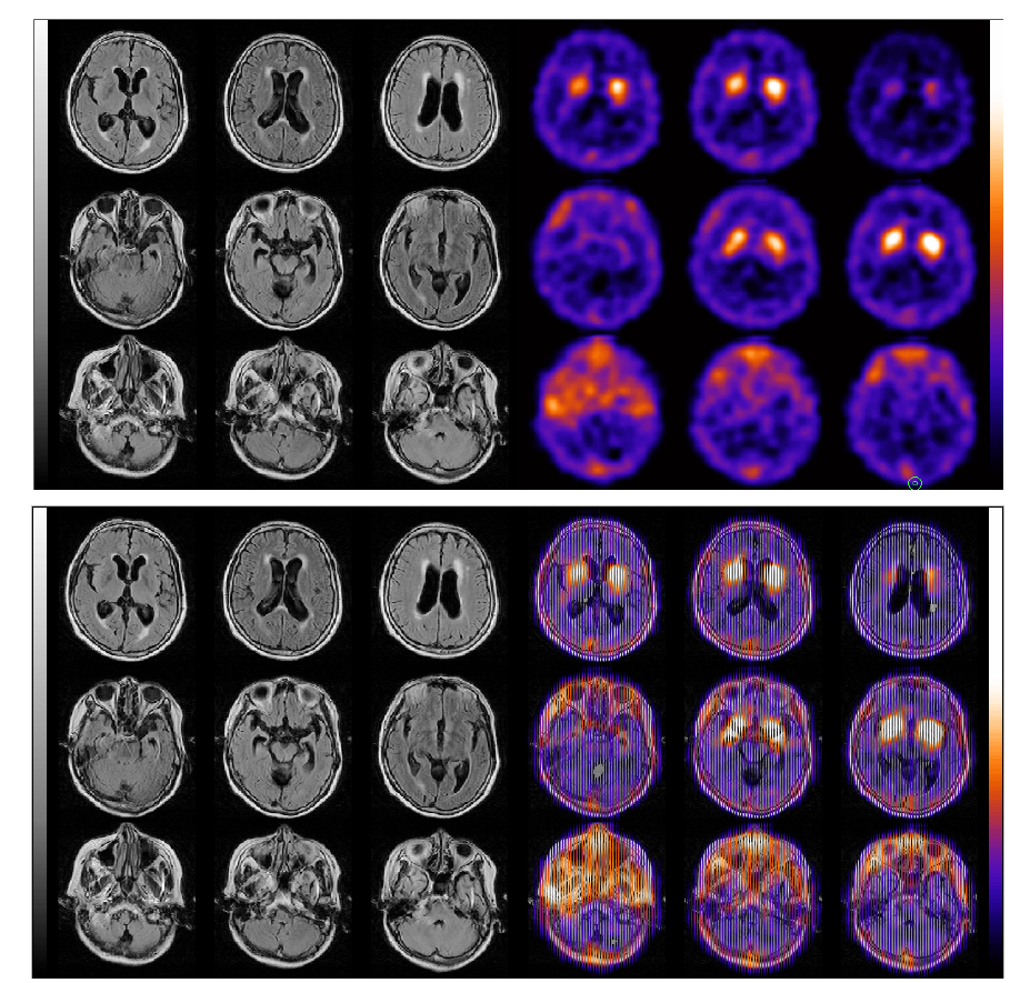 mutual information 기술을 이용한 영상융합 최적화 구현 예시 1: PET-MRI, SPECT-MRI