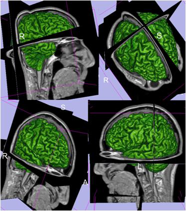 brain volume 3D rendering