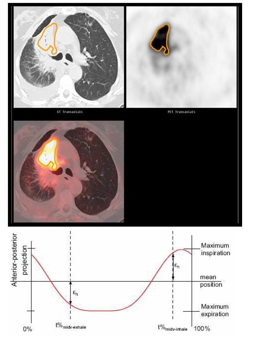 Tumor target delineation using gradient segmentation