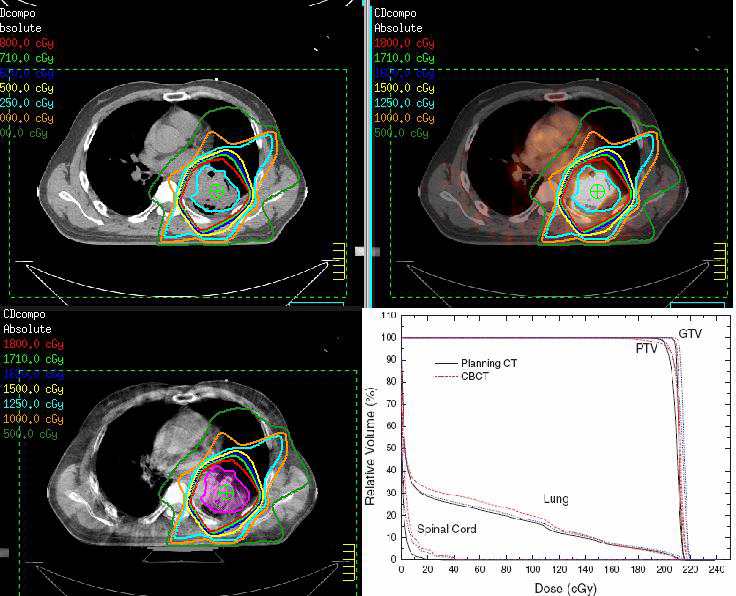 PET-CT 와 kV Cone beam CT의 영상융합및 Adaptive plan