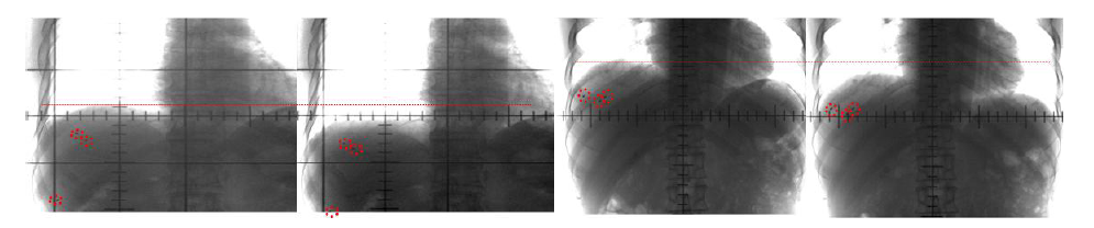 Coronal and axial view of patient #1 exhibiting the location of the 1 position implanted marker in the free breathing CT series in the 50% phase within the lower liver and fluoroscope image.