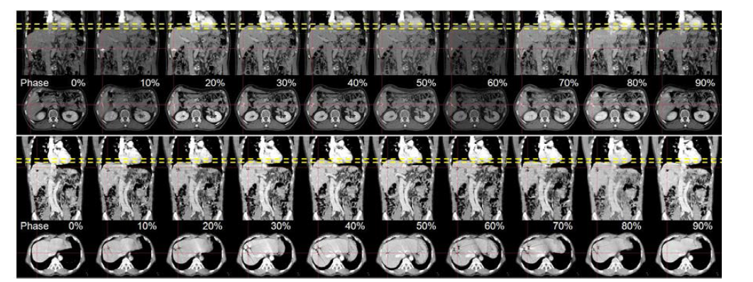 Each phase of a 4D CT image and determination of diaphragm motion in coronal and axial view.