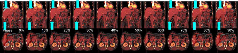 Each phase of a 4D CT image using displacements computed by deformed image registration.