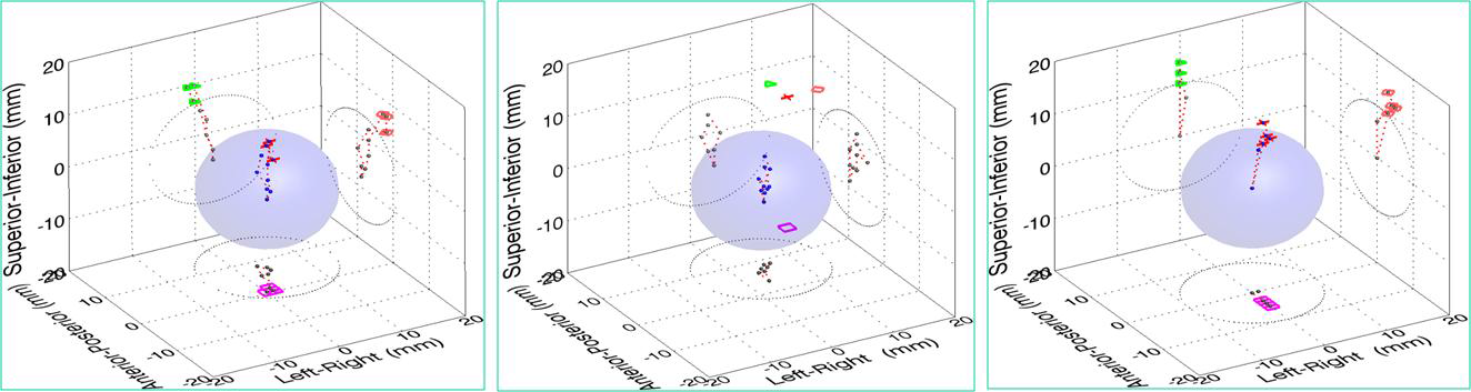 Three seed motion showing hysteresis of the tumor motion (mm) due to respiration.