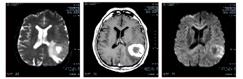 Diffusion tensor imaging을 활용한 종양볼륨분석