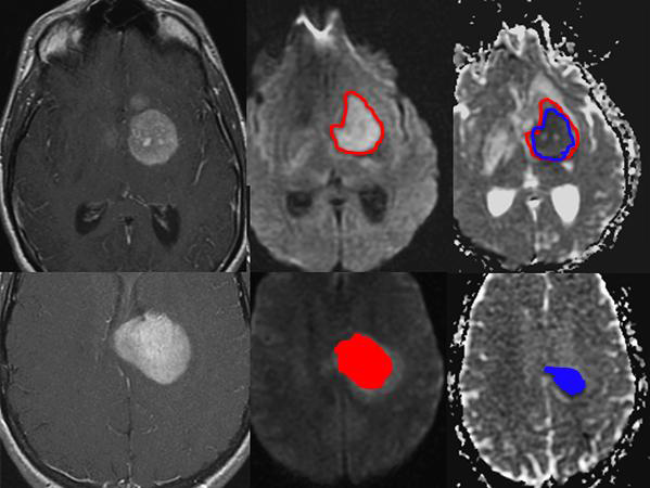 Diffusion tensor imaging을 활용한 종양볼륨분석