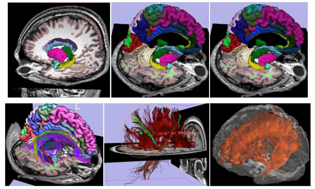 WM fiber tractography and tumor segmentation