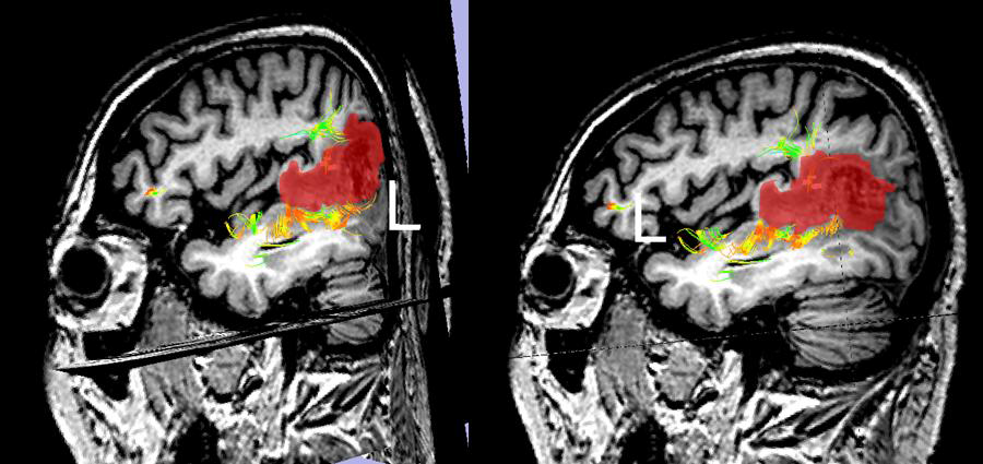 WM fiber tractography and tumor segmentation