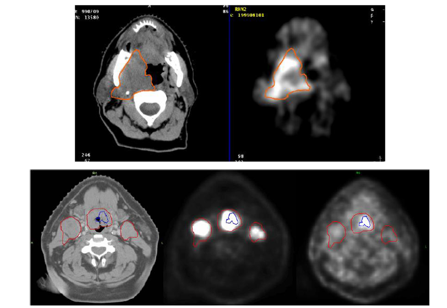 Multiple tumor target ROI based on MRI, and F-18 FDG PET CT상에 나타난 종양볼륨을 최적화하기 어려운 두경부 암종에서는 정상조직의 dose 를 증가시킬 필요없이 hypoxic tumor volume으로 target의 최외경계를 구분하여 방사선치료나 수술시의 dose를 결정할수 있다.