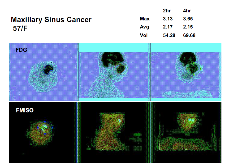 maxillary sinus tumor uptake rate and uptake volume