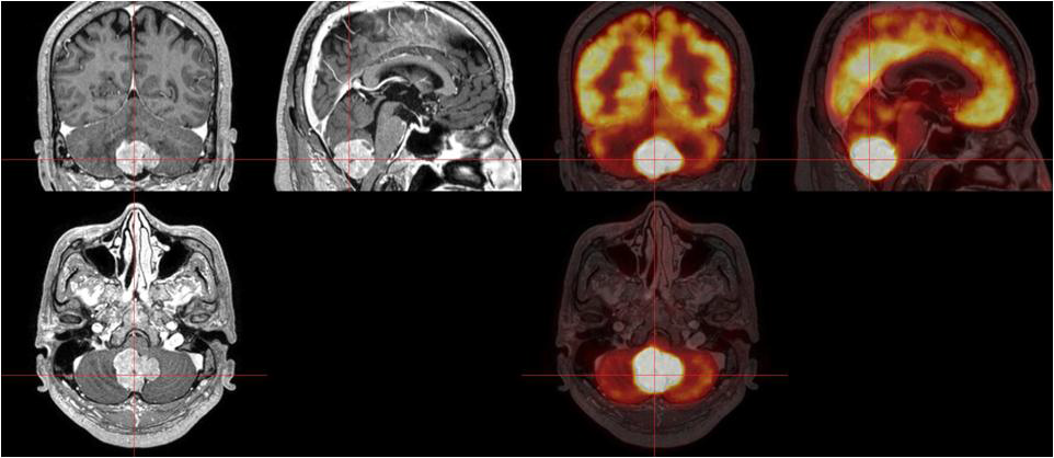 Normalized mutual information image registration with MRI and PET Mutual information I(A,B)를 다음과 같이 구한다.