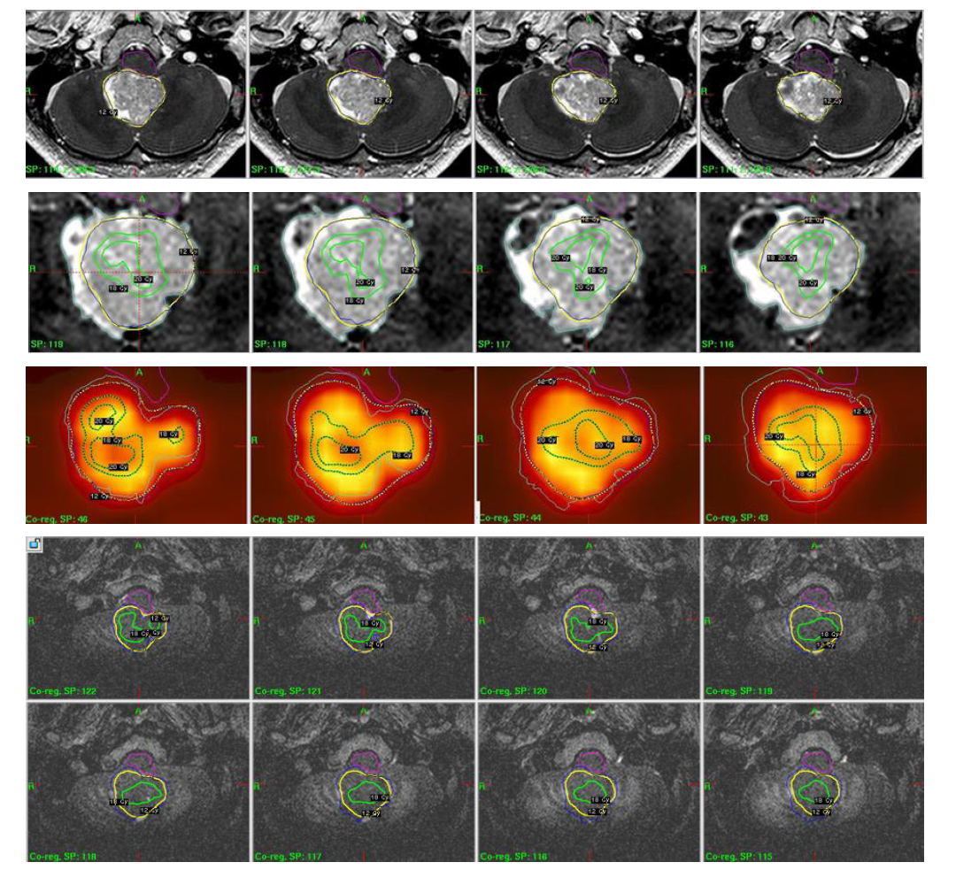 Treatment Planning using optimized tumor targeting