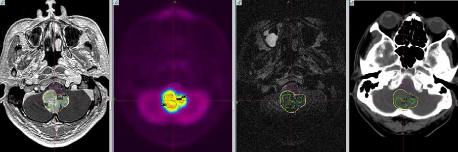 Optimized tumor targeting for planning using multimodal image with MRI PET and CT