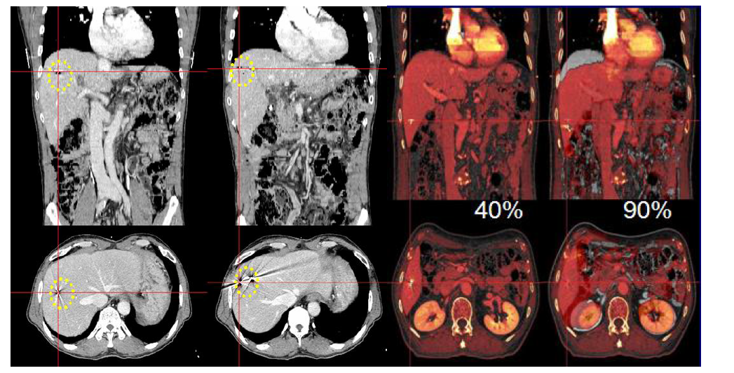 Organ moving hysteris owing to free breathing