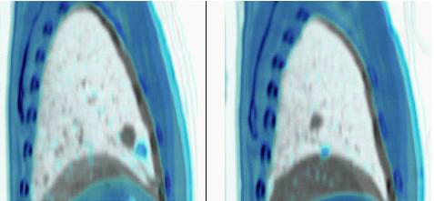 phase 40 %, 90%에서 PET-CT 영상융합.